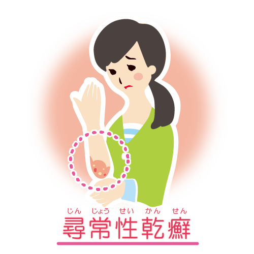 尋常性乾癬の皮膚症状を示すイラスト