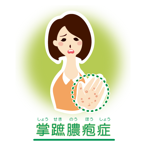 掌蹠膿疱症の手の症状を示すイラスト