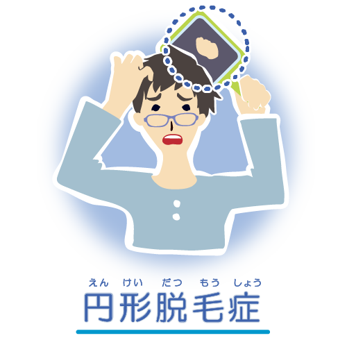 円形脱毛症の脱毛部を示すイラスト