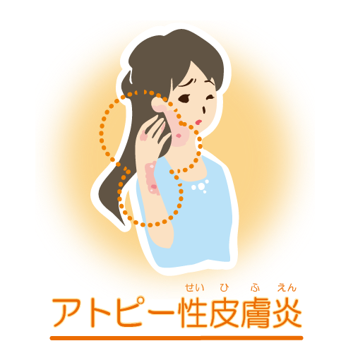 アトピー性皮膚炎の症状を示すイラスト